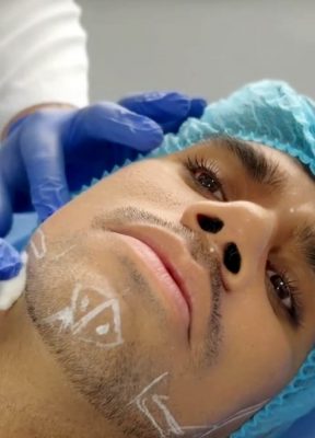 BIOESTIMULADORES CASO CLÍNICO