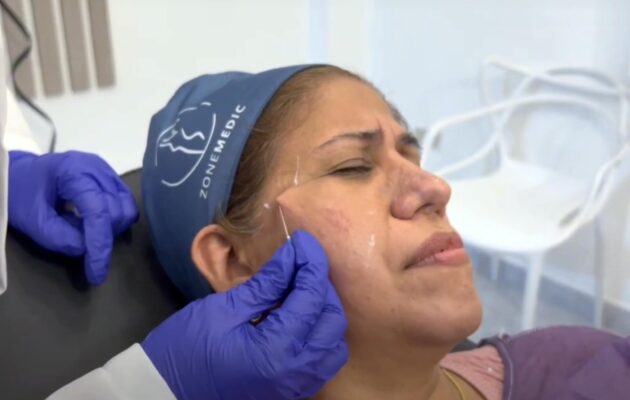 BIOESTIMULADORES CASO CLÍNICO