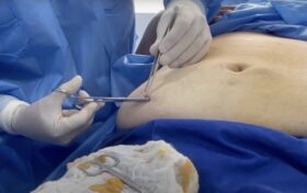 CÉLULAS MADRE APLICACIÓN ESTÉTICA 3