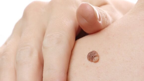 ELECTROCAUTERIZACIÓN LUNARES Y TATUAJES