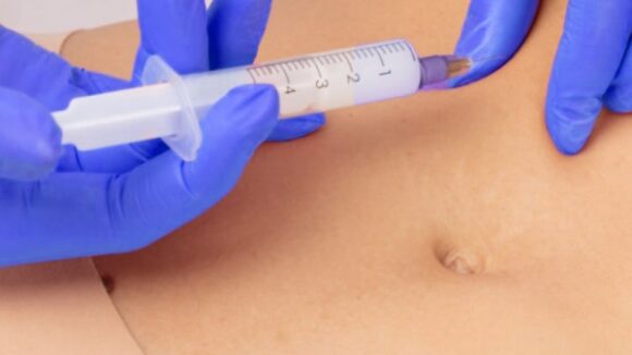 HIDROLIPOLISIS CON SUEROTERAPIA