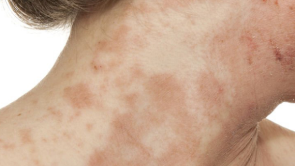 INTRADERMOTERAPIA PIELES SENSIBLES ALERGICAS Y ATOPICAS