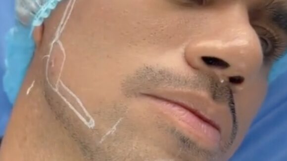 MASCULINIZACIÓN FACIAL