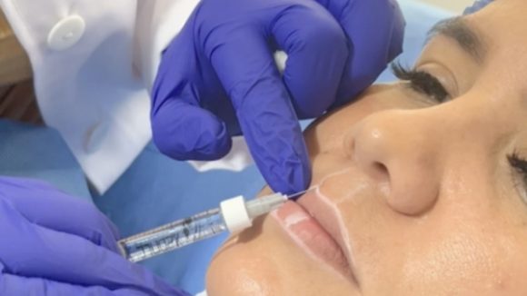 MASTERCLASS FILLERS MÁS TÉCNICA DE INYECCION